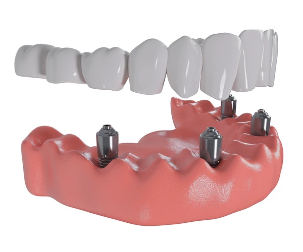 All-on-4 Dental Implants in Fairfax