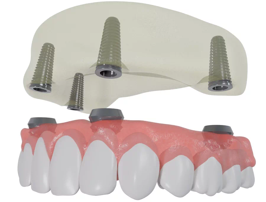 Teeth in a Day