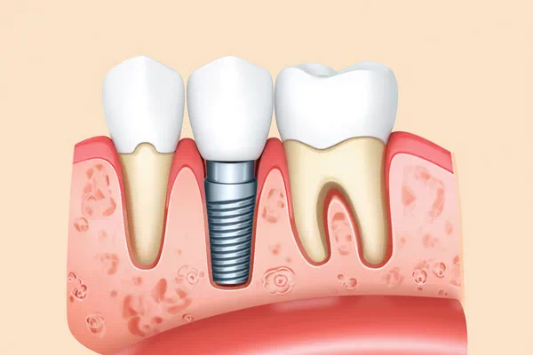 Dental Implants