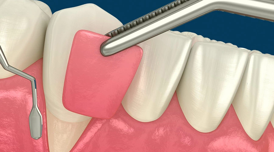 Methods of gum graft