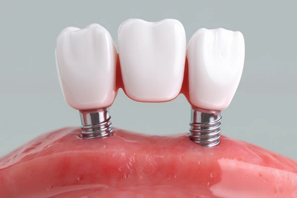 Implant-Supported Dental Bridge