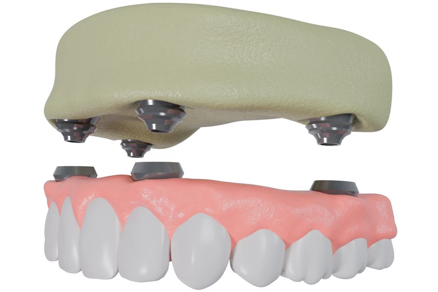 What’s Involved in Your All-on-4 Treatment