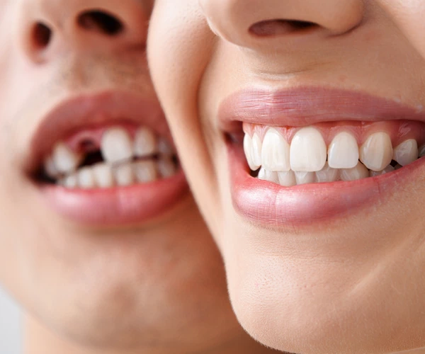 Placement of dental bridges