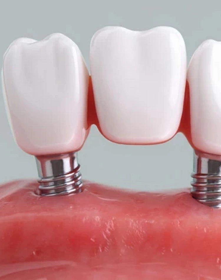 Cost of Dental Crowns