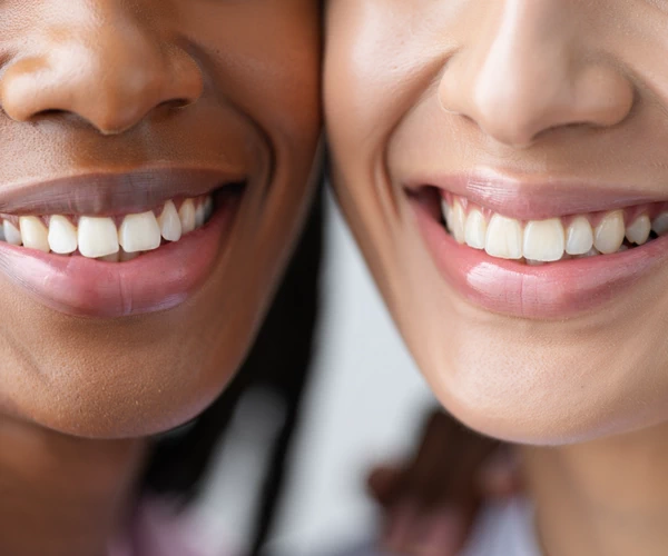Benefits of Porcelain Veneers