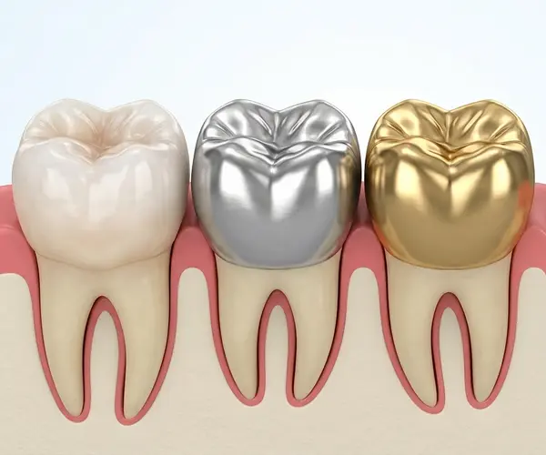 Dental Crowns in Fairfax