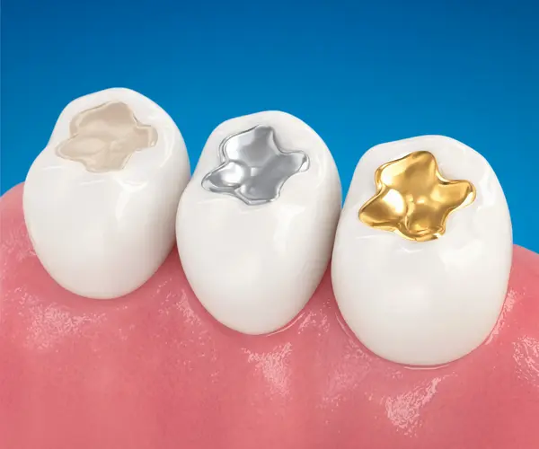 Composite Fillings