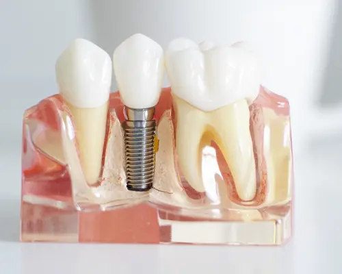 Dental Implants